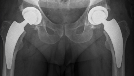 Post OP Roentgenbild